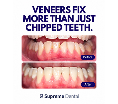 Supreme Dental Veneers